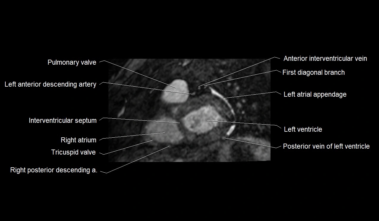 MRI heart and coronary arteries short axis anatomy image 21.webp